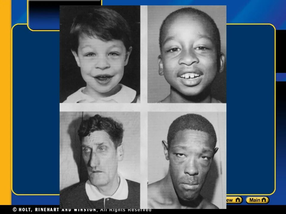 болезни на х хромосоме у человека. хромосомные заболевания примеры. синдром клайнфельтера причины. синдром дауна тип наследовани. хромосомные болезни причины классификация.