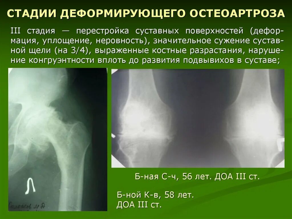 Доа коленного сустава 3 степени рентген. Доа коленных суставов 3 ст рентген. Доа тазобедренного сустава рентген.