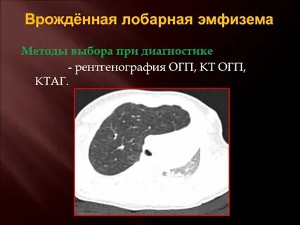 Врожденная долевая эмфизема