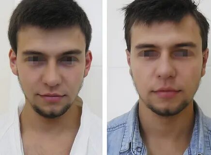 Операция на уши