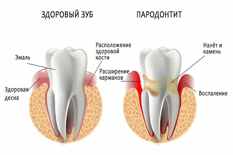 Пародонт реферат. Патогенез воспалительных заболеваний пародонта. пародонтальный этиология патогенез. патогенез пародонтита схема. здоровый зуб гингивит пародонтит.
