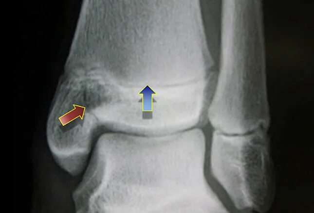 Эпифизарный перелом лодыжки. Эпифизеолиз наружной лодыжки рентген. Перелом эпифизеолиз большеберцовой кости. Эпифизеолиз голеностопного сустава.