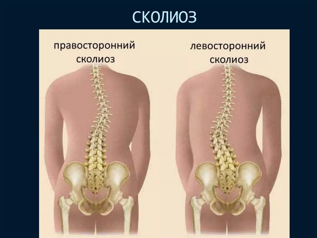 Сколиоз 3 степени лечение. Сколиоз грудного отдела позвоночника. боковое искривление позвоночника. сколиоз позвоночника 2 степени.
