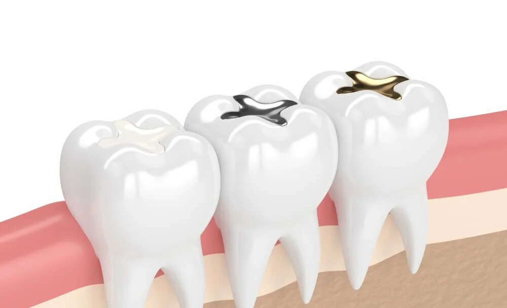 Tooth filling. Tooth filling