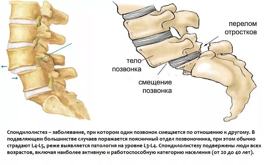 Перелом Нижнего суставного отростка l5. Перелом остистого отростка l5 рентген. Спондилолистез l1, l2, l3.. Перелом остистого отростка s1. Операция смещение позвоночника