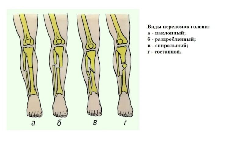 Тест перелом костей голени. Перелом берцовая кость кости. Тест перелом костей голени. Переломы костей голени классификация. Классификация повреждений голени.