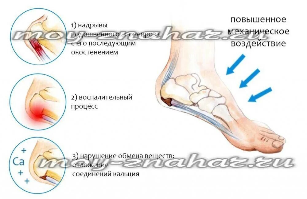 Пятка как будто