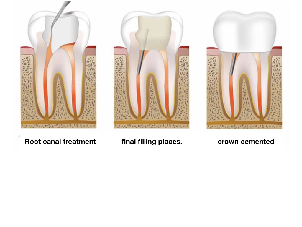 Root canal. Наращивание зуба на корень. Депульпирование зуба (удаление нерва).