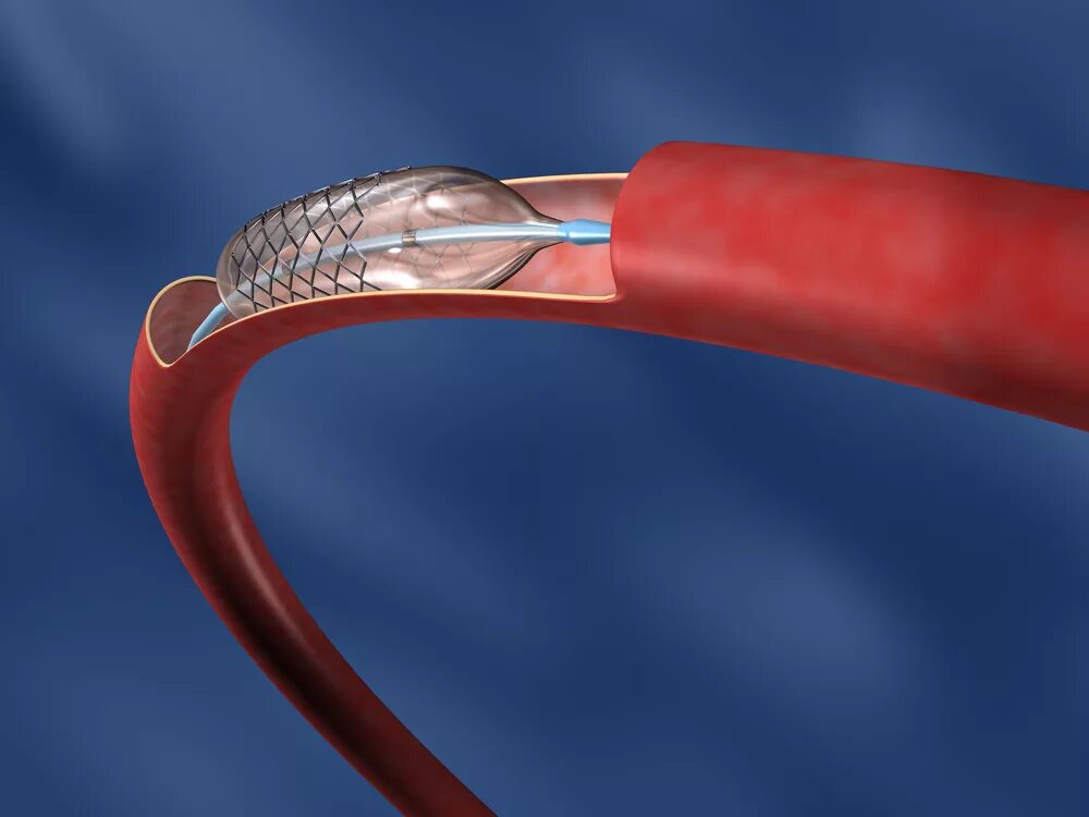 Стентирование сосудов последствия. Коронарное стентирование. Стентирование коронарных сосудов. Стенты для коронарных сосудов производители.