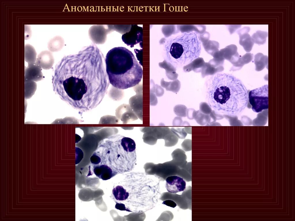 Метастазы в костном мозге. Клетка при болезни гоше. селезенка при болезни гоше микропрепарат. клетки в костном мозге при болезни гоше. болезнь гоше микропрепарат.