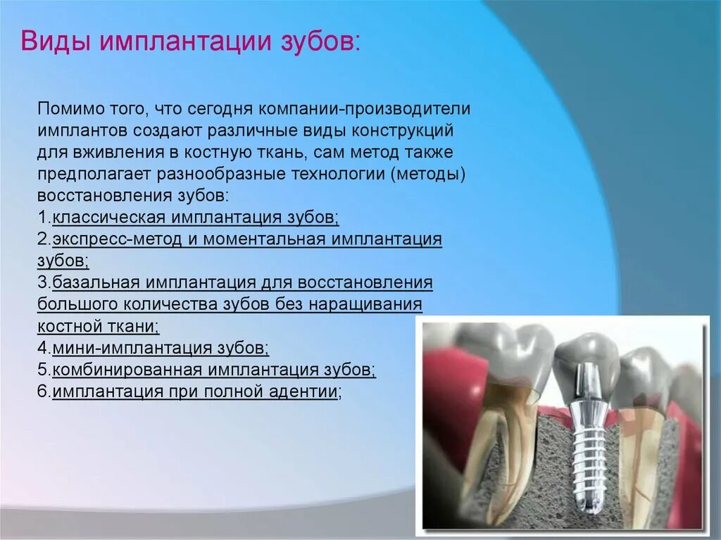 Виды имплантации