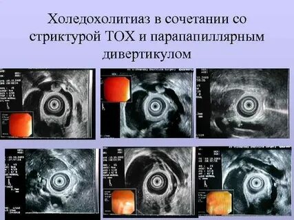 Холедохолитиаз это