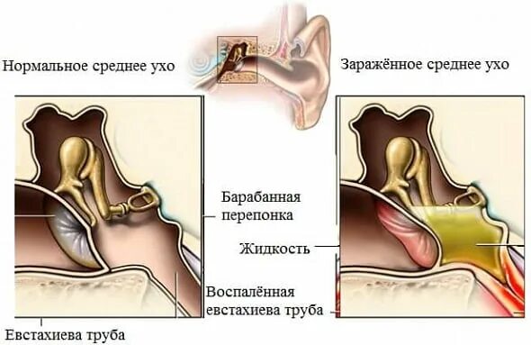 Тубоотит пройти