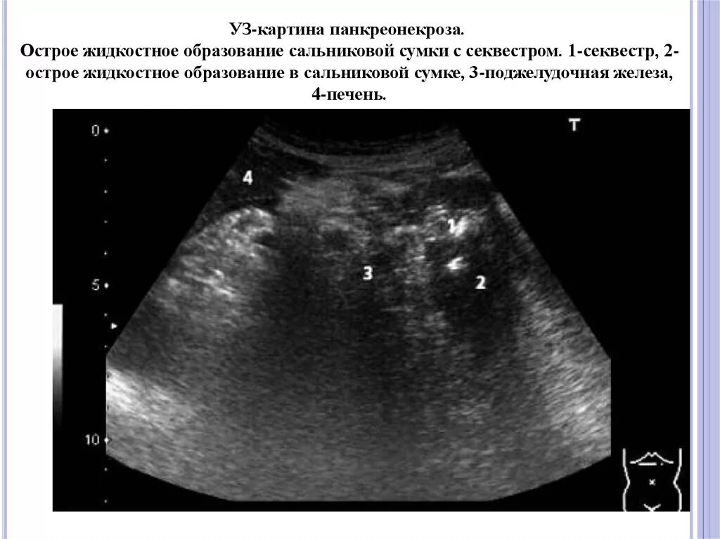 Что такое некроз поджелудочной железы у мужчин. Некроз поджелудочной железы на УЗИ. Острый панкреатит панкреонекроз УЗИ. Ультрасонография поджелудочной железы. Панкреонекроз поджелудочной железы на УЗИ.