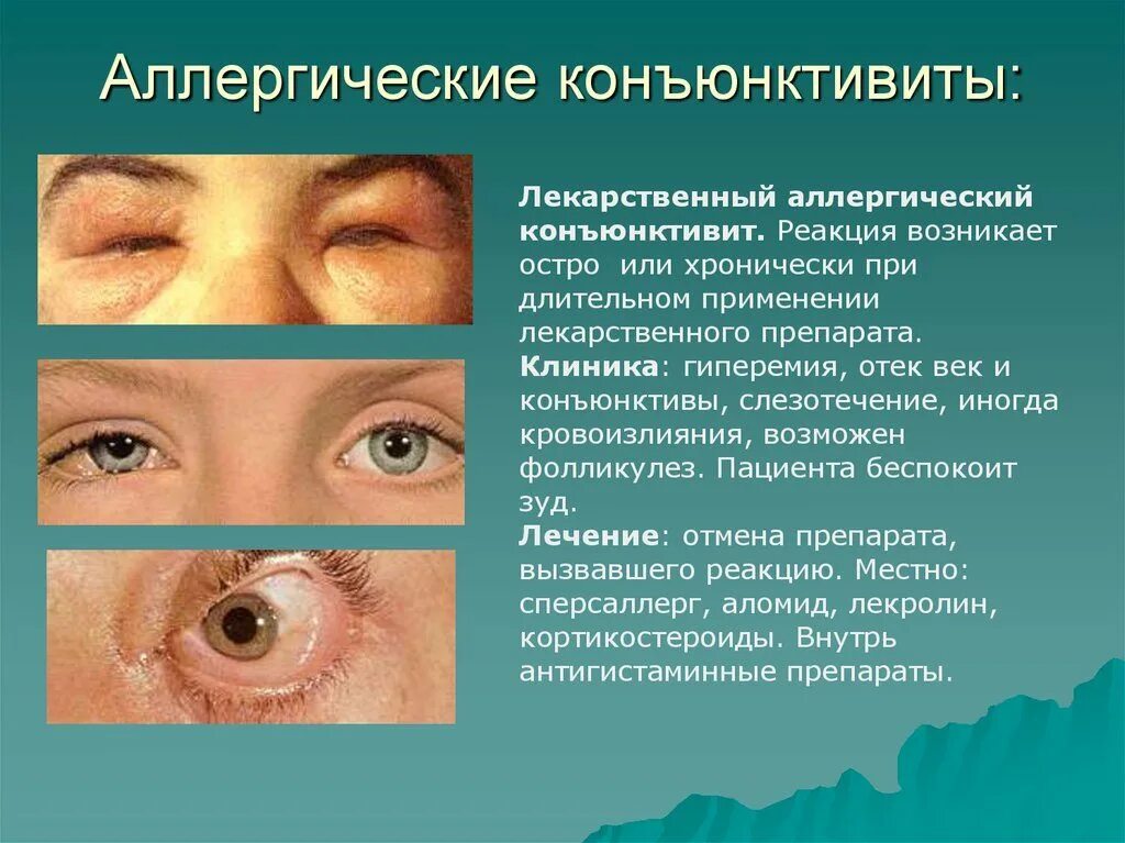 Основные клинические проявления аллергического конъюнктивита. Симптомы конъюнктивита глаз. Гнойное воспаление глаз. Конъюнктивит воспаление.