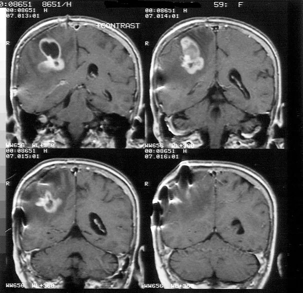 Локализация опухоль головного мозга классификация. Отёк, дислокация головного мозга мкб 10. Локализация опухоли головы. Объемное образование головного мозга по мкб 10. Новообразование головного мозга код мкб.