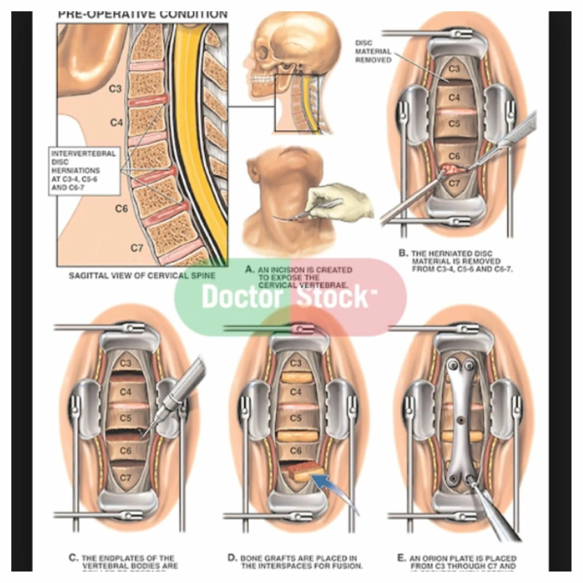 Диск c5 c6. Диск c5/c6 расположение. cervical disc herniation. c5 c6.