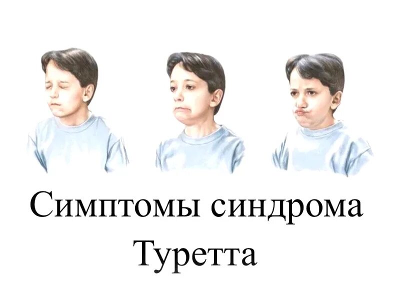Синдром т. Синдром туретта симптомы. синдром жиль де ла туретта. синдром туретта синдромы симптомы. синдром туретта признаки.