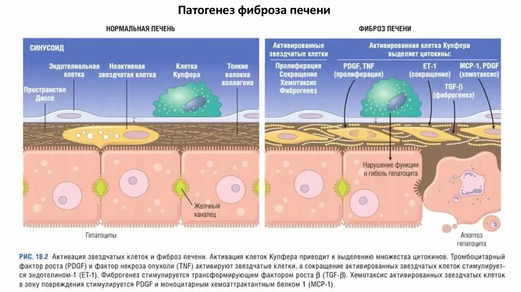 Сколько живут фиброзом 4. Патогенез цирроза печени. Стадии фиброза. Фиброзные септы это в печени.