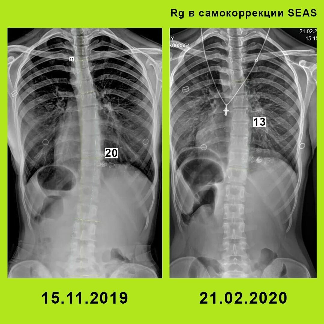Сколиоз позвоночника рентген степени. Сколиоз 2 степени рентген. Рентген спины сколиоз 2 степени. Сколиоз 2 степени угол искривления.