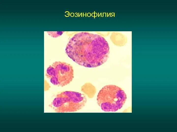 Эозинофилия мкб. Эозинофилия этиология. лейкопения эозинофилия. эозинофилия при лейкозе. механизм эозинофилии.
