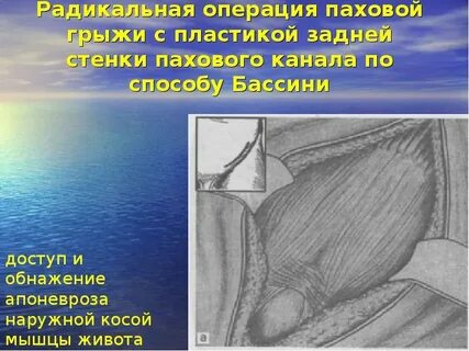 Пластика передней стенки пахового канала