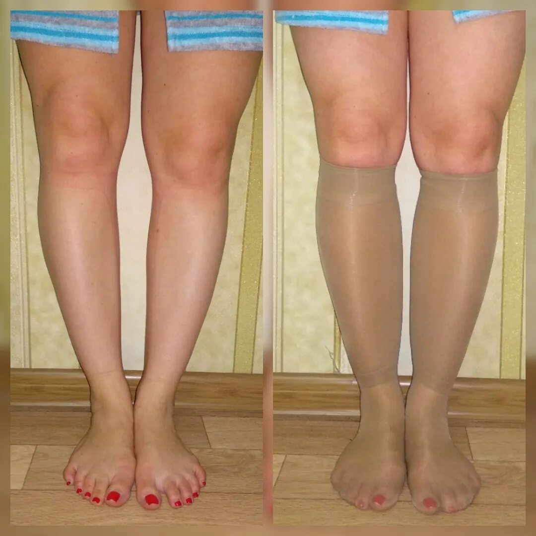 Круропластика мариничева. Аппарат илизарова вальгусная. Аппарат илизарова на голень. Исправление ног. Аппарат илизарова х образные ноги.