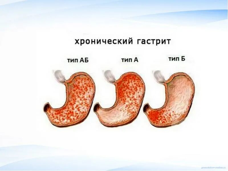 Виды хронического гастрита. Типы гастрита. Хронический пангастрит.