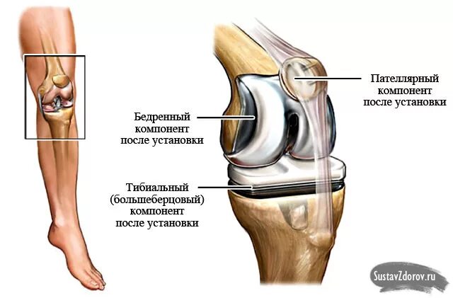 Повреждение коленного сустава 3 степени. Гонартроз коленного сустава эндопротез. ТЭП эндопротезирование коленного сустава. Модульный эндопротез коленного сустава цито. Колено после эндопротезирования коленного сустава.