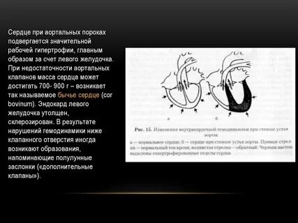 Аортальные пороки