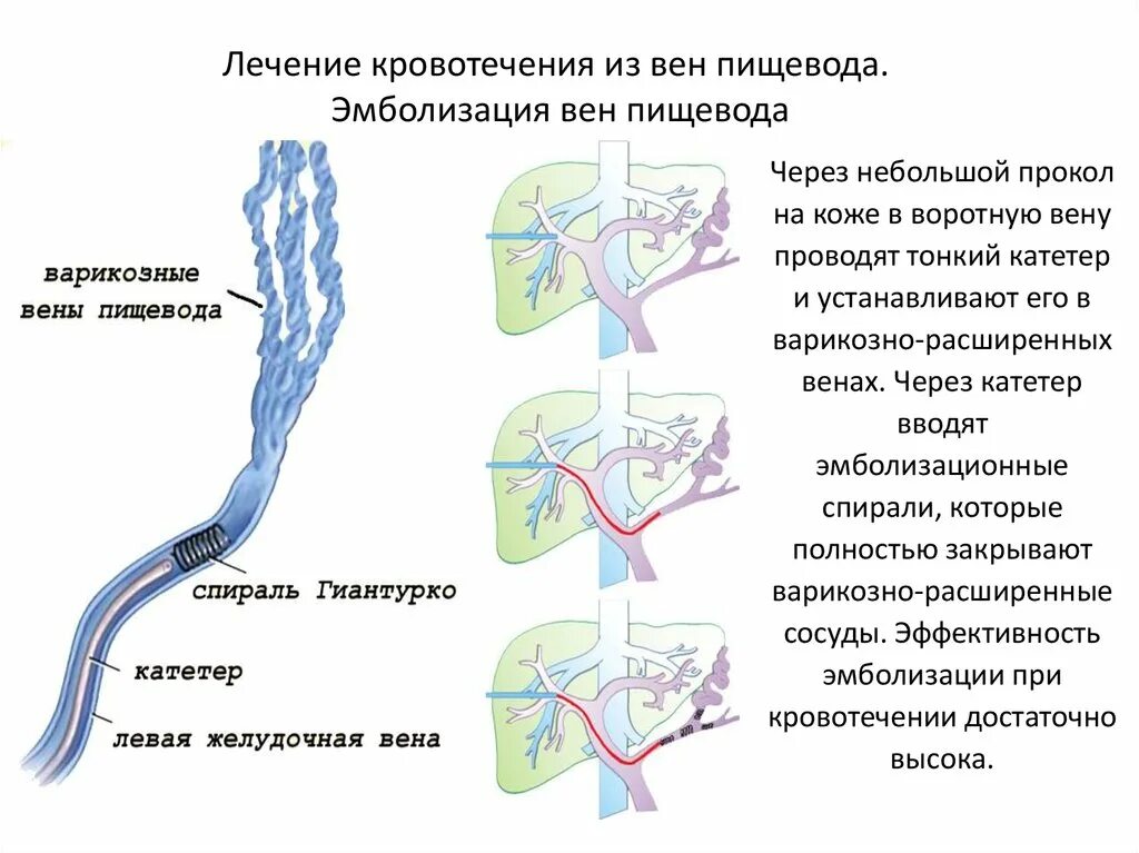 Лечение вен пищевода