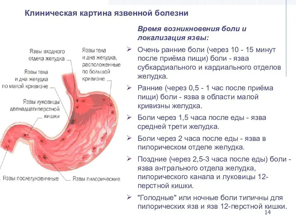 Болит живот сразу после еды. Язвенная болезнь желудка локализация. Кислотность при язвенной болезни желудка. Язвенная болезнь пилорического отдела желудка. ЖКТ болезни ДПК И язва желудка.