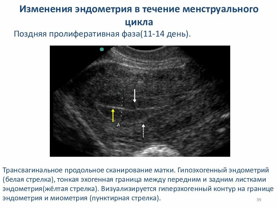 Эндометрий слой норма. Толщина эндометрия в 1 фазу менструального цикла. Толщина эндометрия по дням цикла по УЗИ. Норма эндометрия по УЗИ. Эндометрий на УЗИ норма.