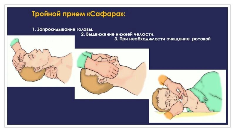 Реанимация положение головы. Тройной прием сафара алгоритм. тройной прием сафара при слр. сердечно легочная реанимация тройной прием сафара.