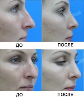 Ринопластика самара