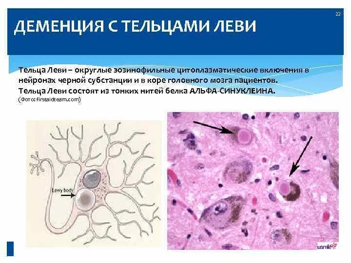 Деменция с тельцами Леви. Деменция с тельцами Левина. Деменция с тельцами Леви симптомы. Тельца Леви.