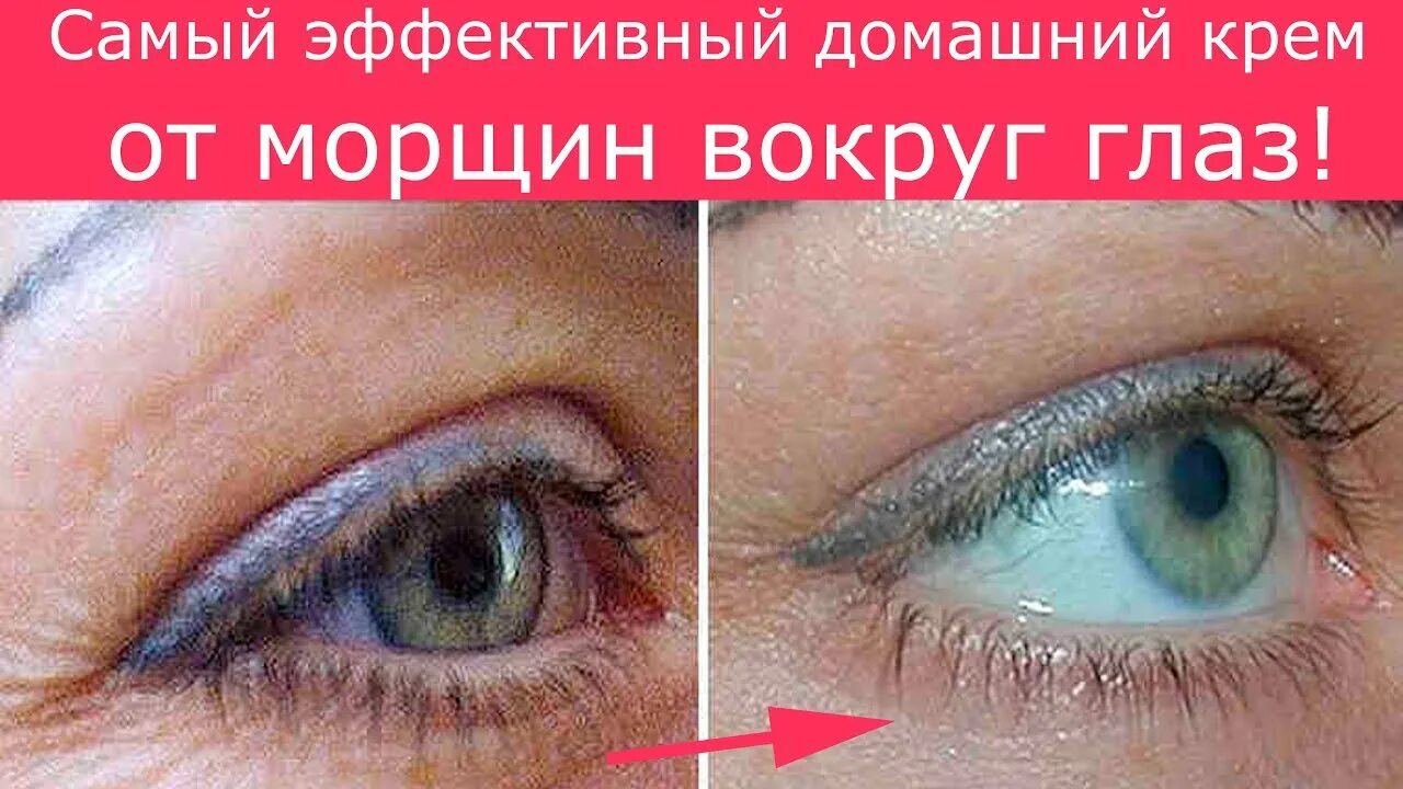 Как уплотнить кожу под глазами. Морщины вокруг глаз. складки под глазами.