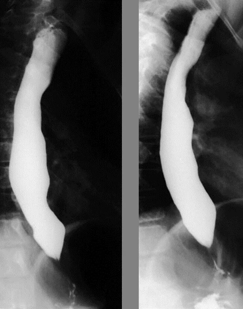 Лучевая пищевода. Ахалазия кардии пищевода. Ахалазия кардии рентген.