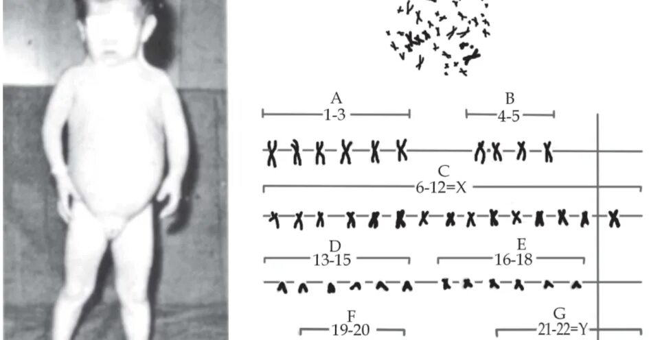 Синдром тельце. Синдром Циммермана-Лабанда. Cromozomii. Синдром меркельсона Розенталя.