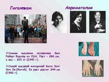 Гигантизм сахарный диабет