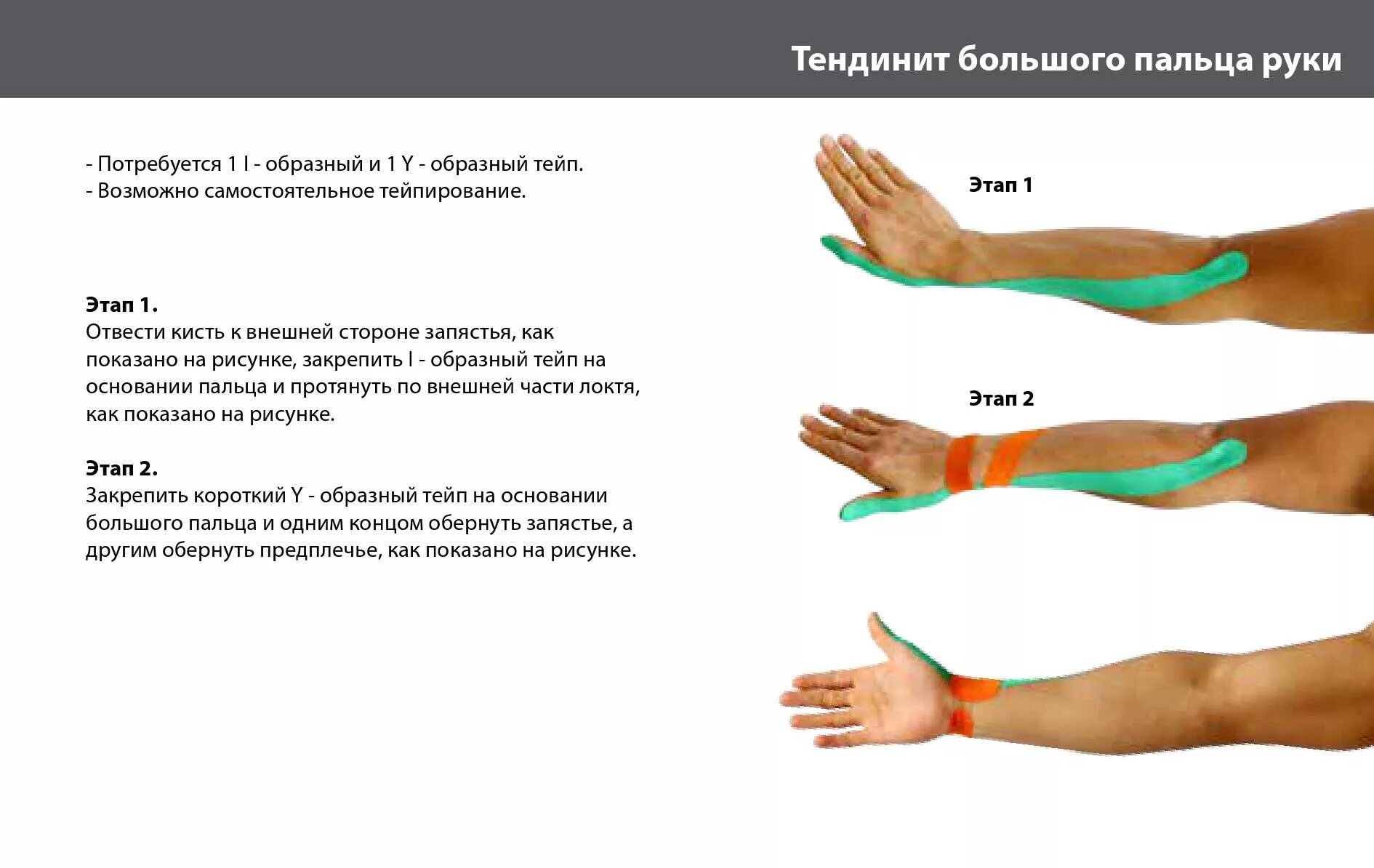 Тейпирование запястья схема. Болезнь де Кервена тейпирование. Тейпирование запястья туннельный синдром. Тейпирование при туннельном синдроме кисти руки. Боль в кистях рук и запястьях