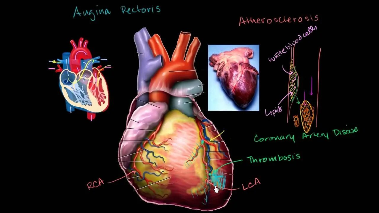 Coronary heart disease. Атеросклероз коронарных сосудов. Атеросклероз сердца человека. Атеросклероз сосуды вектор. Здоровое и больное сердце.