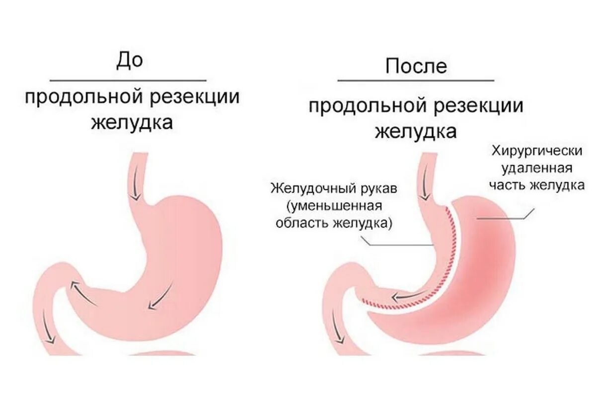 Как делается резекция желудка. Продольная (рукавная) резекция желудка. калибровочный зонд для продольной резекции желудка. продольная резекция желудка (sleeve).