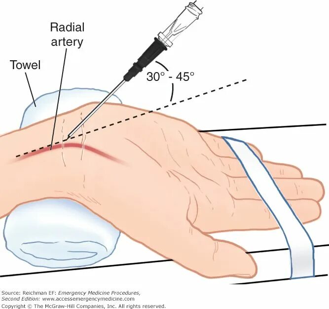 Into procedure