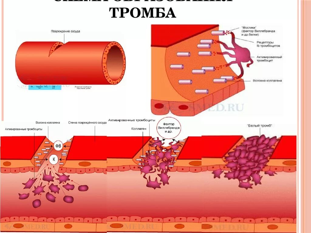 Схема образования красного тромба. Тромбоциты повреждение сосуда схема. Тромбоз механизм тромбообразования. Этапы образования тромба схема. Части тромбов