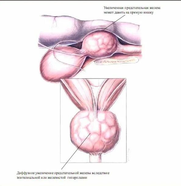 Патология предстательной железы. Увеличение предстательной железы. Форма предстательной железы.