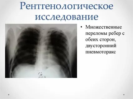 Перелом ребер мкб