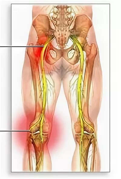 Нерв в правой ягодице. Седалищный нерв. Седалищный нерв анатомия. Защемление седалищного нерва анатомия. Седалищный нерв нерв.