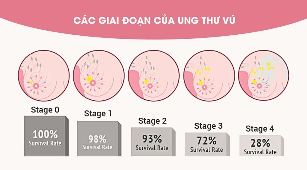 Stages if breast Cancer. Stages of cancer