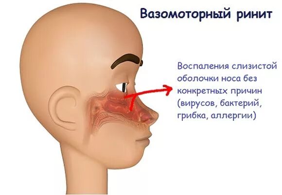 Снять отечность при насморке